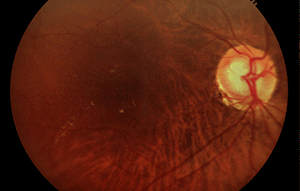 Le glaucome entraine une perte de la vue en abimant le nerf optique