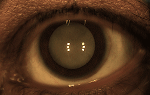 Une cataracte est une opacification du cristallin d'un œil, ce qui entraîne une perte de vision